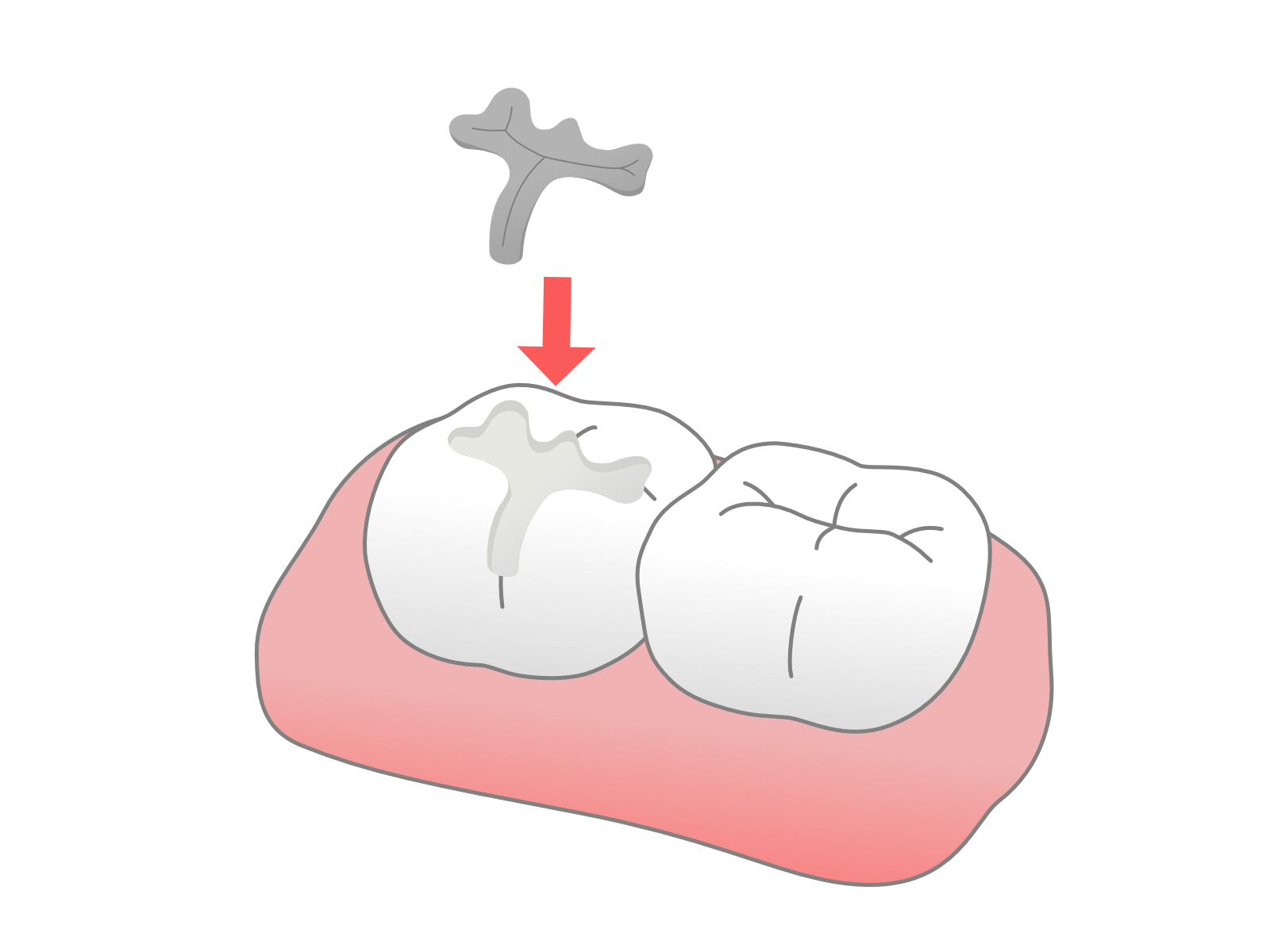 インレーの特徴